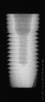 Radiograph of OsseoLink
