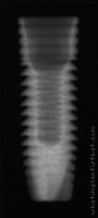 Radiograph of OsseoLink