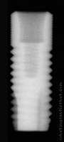 Radiograph of Astra Tech Osseospeed 4.0 S