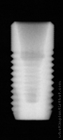 Radiograph of Astra Tech Osseospeed 5.0 S
