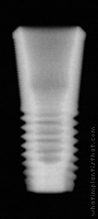 Radiograph of Astra Tech Osseospeed 5.0
