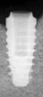 Radiograph of Perioseal