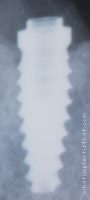 Radiograph of WIS Externo Conico