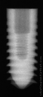 Radiograph of Pitt-Easy - TPS