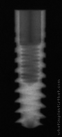Radiograph of Pitt-Easy - TPS