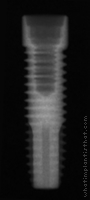 Radiograph of PrimaConnex Straight