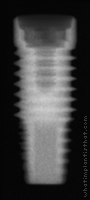 Radiograph of PrimaConnex Straight