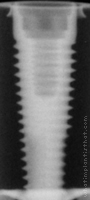 Radiograph of PrimaConnex Tapered