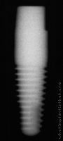 Radiograph of PrimaSolo One Piece Tapered