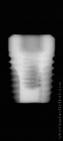 Radiograph of ProActive