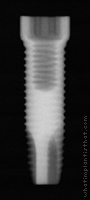 Radiograph of ProActive
