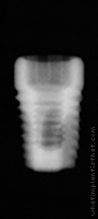 Radiograph of ProActive