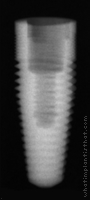 Radiograph of RePlant