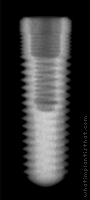 Radiograph of RePlus