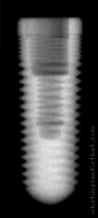 Radiograph of RePlus