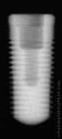 Radiograph of RePlus