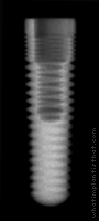 Radiograph of RePlus