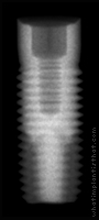 Radiograph of Renova RBM Straight