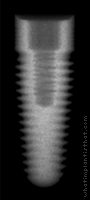 Radiograph of Renova RBM Tapered