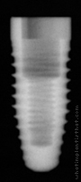 Radiograph of Replace Select