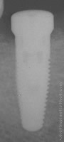 Radiograph of Replant