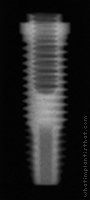 Radiograph of Restore RD