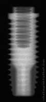 Radiograph of Restore WD