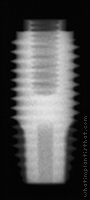 Radiograph of Restore WD