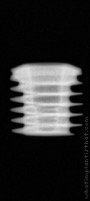 Radiograph of Implance | S-BMFSR5505 – bone level short