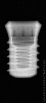 Radiograph of Implance | S-TFSR4305 – tissue level short