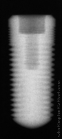 Radiograph of ScrewPlant