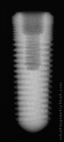 Radiograph of ScrewPlant