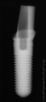 Radiograph of ScrewRedirect