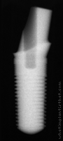 Radiograph of ScrewRedirect