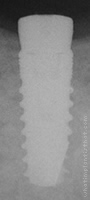 Radiograph of Seven (Wide Platform)
