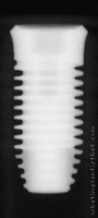 Radiograph of Single-stage RBT, Laser-Lok