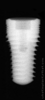 Radiograph of Legacy 2