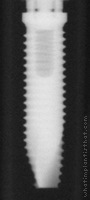 Radiograph of Calcitek Spline Twist