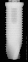 Radiograph of Calcitek Spline Twist