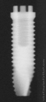 Radiograph of Calcitek Spline Twist