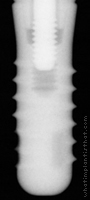 Radiograph of Stage-1