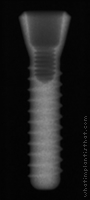 Radiograph of Stage-1 RDS