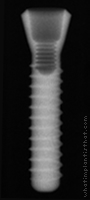 Radiograph of Stage-1 RDS