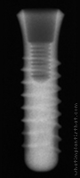 Radiograph of Stage-1 RDS