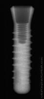 Radiograph of Stage-1 RDS