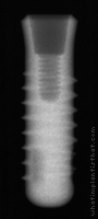 Radiograph of Stage-1 RDS