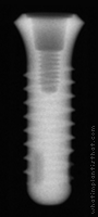 Radiograph of Stage-1 RDS