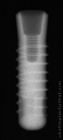 Radiograph of Stage-1 WDS