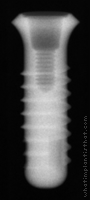 Radiograph of Stage-1 WDS