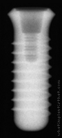 Radiograph of Stage-1 WDS